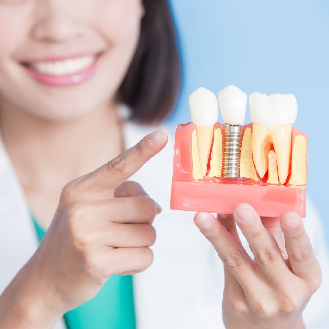 ¿Cuánto duran los implantes dentales? Consejos para un buen mantenimiento