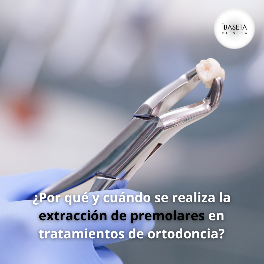 ¿Por qué y cuándo se realiza la extracción de premolares en tratamientos de ortodoncia?